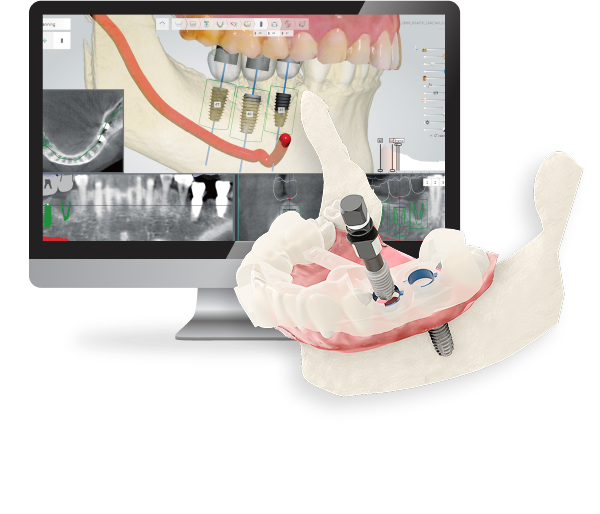 Digital Implant Systems