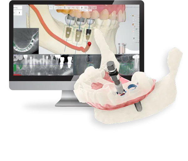 DIO Navi Digital Implant System