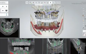 Digital simulation for guided implant surgery planning